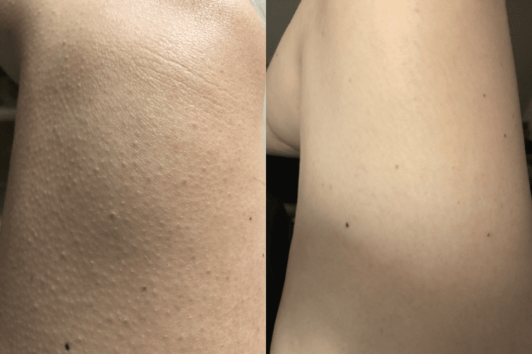 before and after keratosis pilaris on my legs